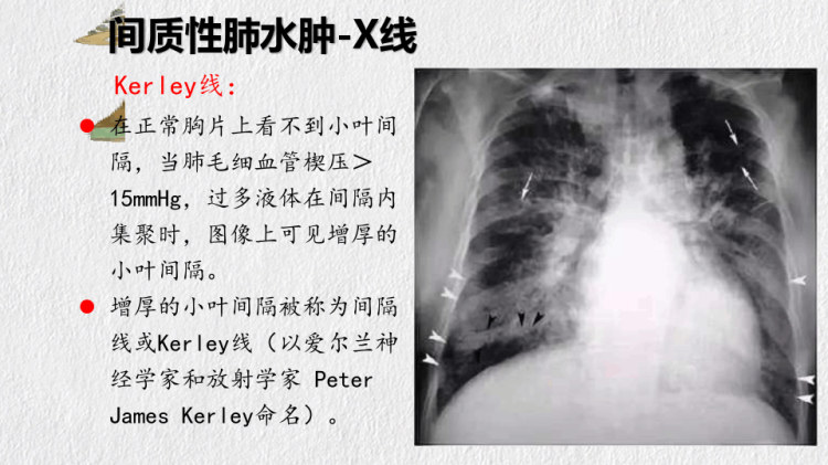 肺水肿形成分类与意义PPT