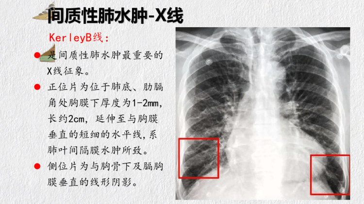 肺水肿形成分类与意义PPT