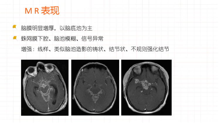 结核性脑膜炎的影像表现PPT