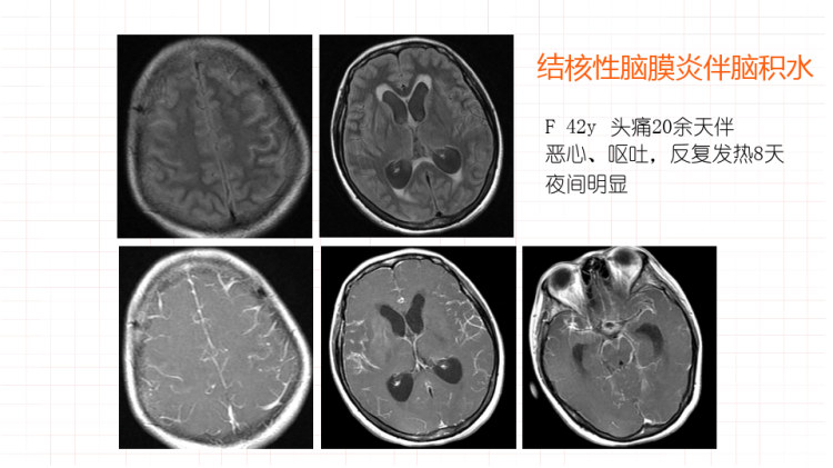 结核性脑膜炎的影像表现PPT