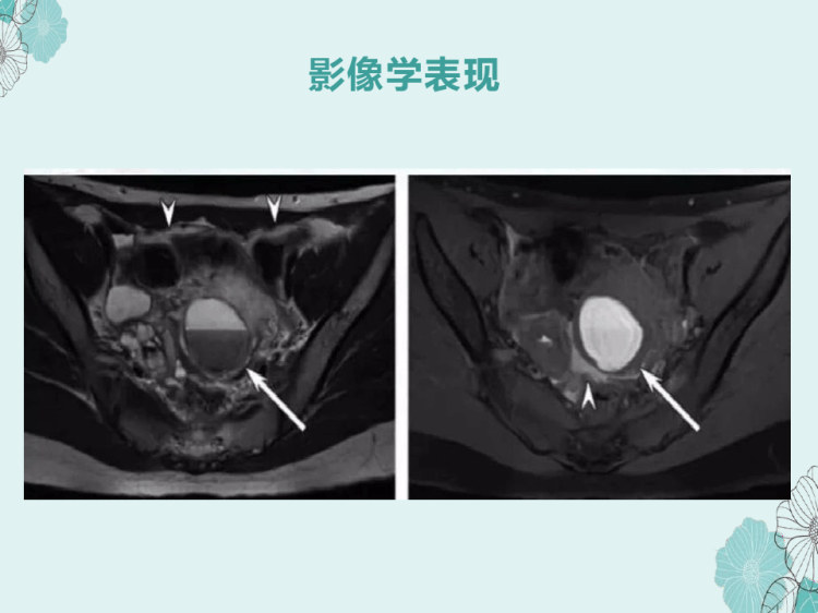 子宫内膜异位症与子宫腺肌症影像表现PPT