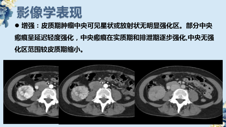 肾嗜酸细胞腺瘤的影像诊断与鉴别诊断PPT