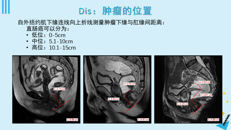 直肠周围相关解剖与直肠癌的分期诊断PPT