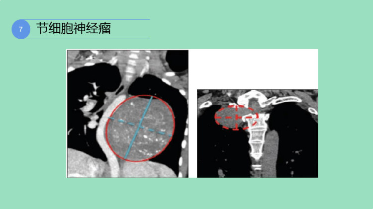 纵隔神经源性肿瘤的影像表现PPT