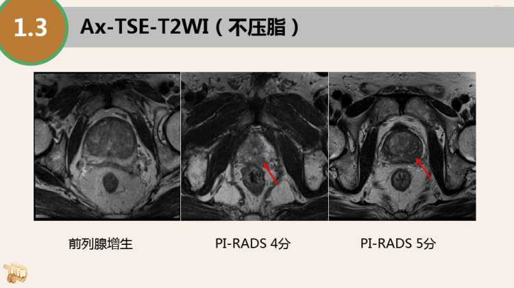 男性盆腔MRI检查规范PPT