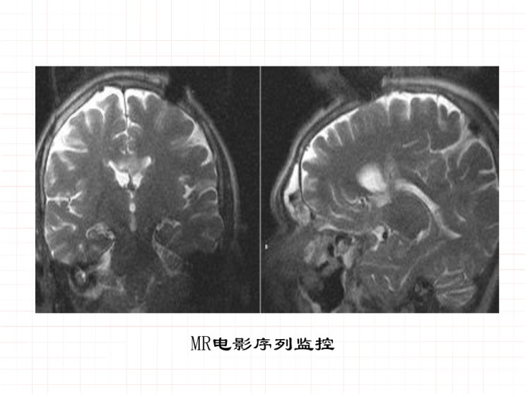非血管性介入放射学PPT