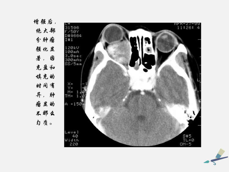 眼眶肿瘤CT诊断和鉴别诊断PPT