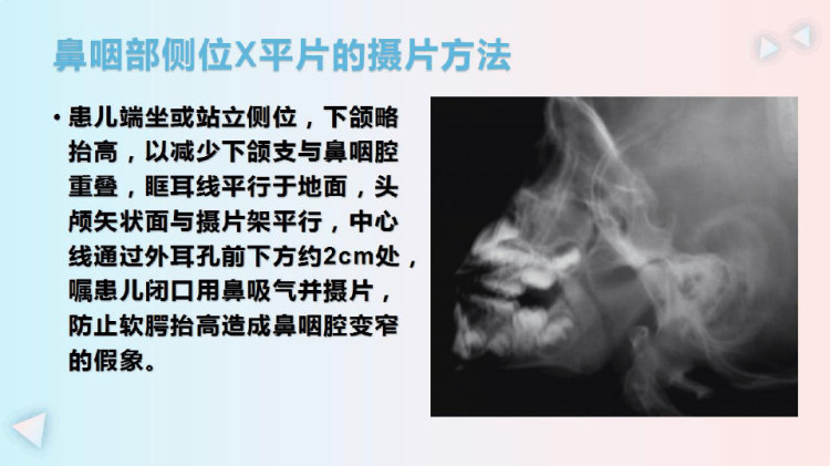 儿童腺样体肥大的X线摄片及影像诊断PPT
