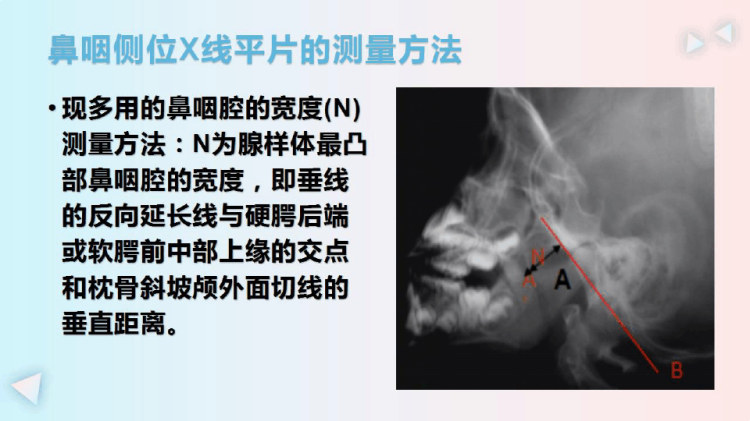 儿童腺样体肥大的X线摄片及影像诊断PPT