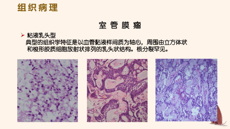 脊髓室管膜瘤与星形细胞瘤的影像表现PPT