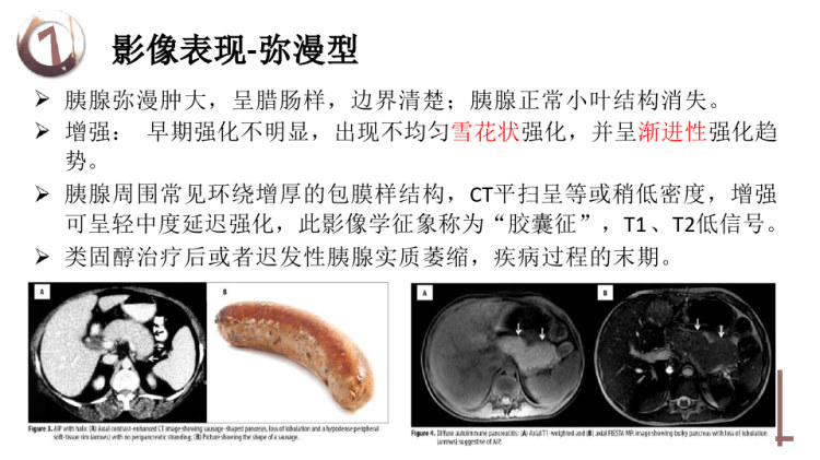 IgG相关性自身免疫性胰腺炎的影像诊断与鉴别诊断PPT