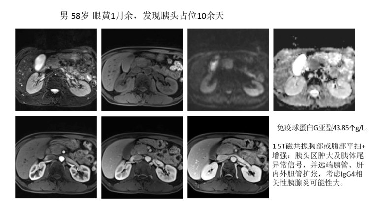 IgG相关性自身免疫性胰腺炎的影像诊断与鉴别诊断PPT