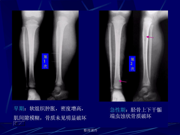 化脓性骨髓炎的影像学诊断PPT