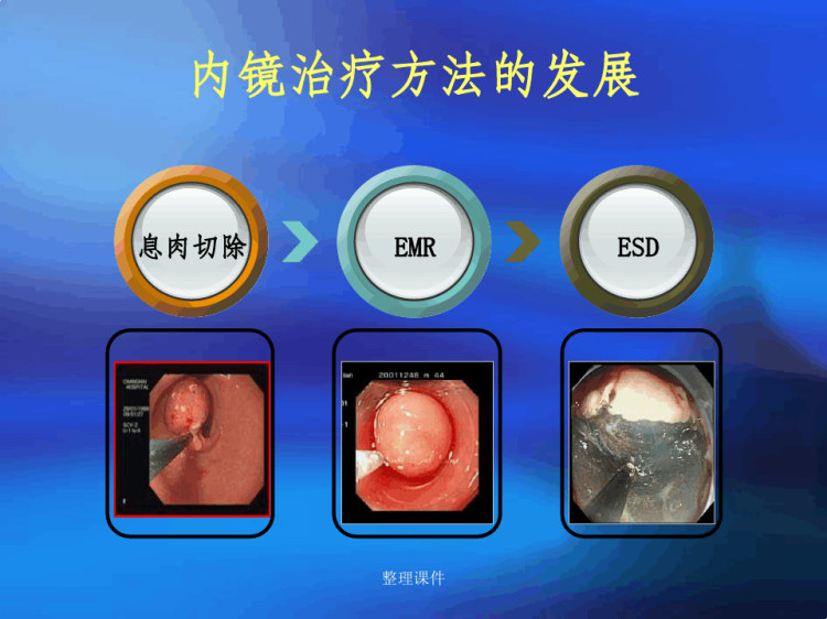 《内镜下粘膜切除术》PPT