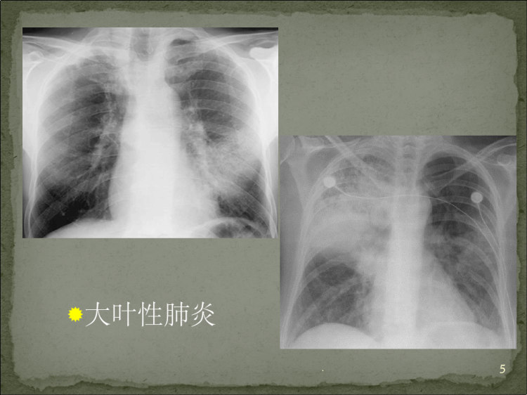 肺炎影像诊断PPT