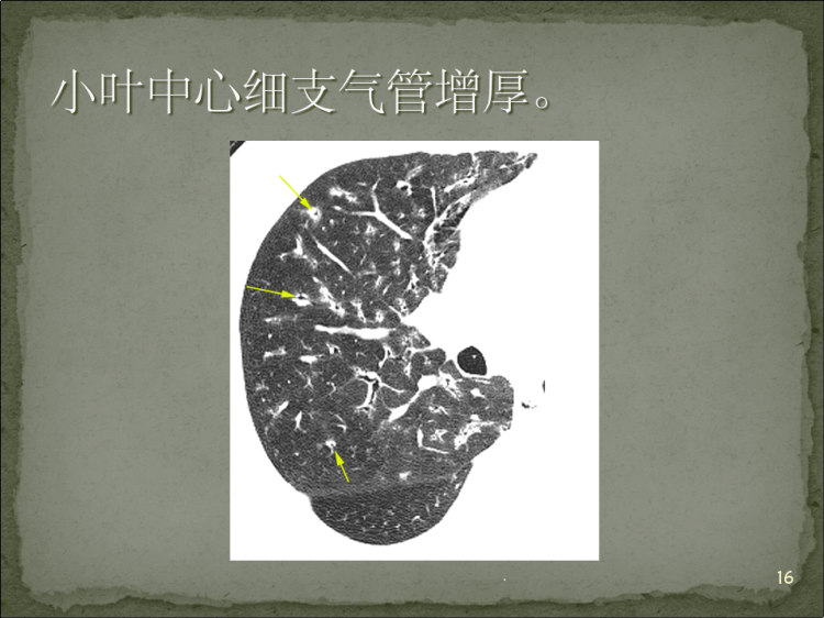 肺炎影像诊断PPT