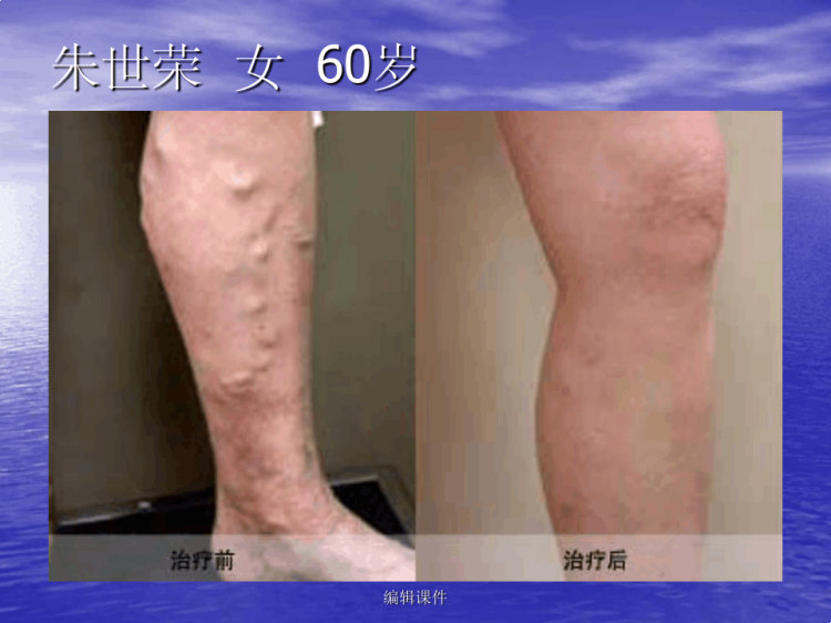 腔内激光治疗下肢静脉曲张PPT
