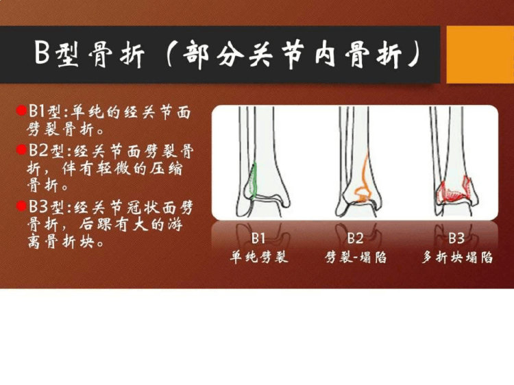 《Pilon骨折概述》PPT