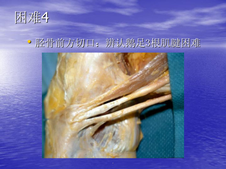 前交叉韧带重建中后侧小切口腘绳肌腱取腱方法PPT