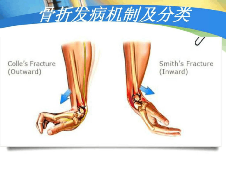 桡骨远端骨折经典教学PPT