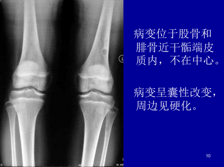 纤维骨皮质缺损CTMRI诊断PPT