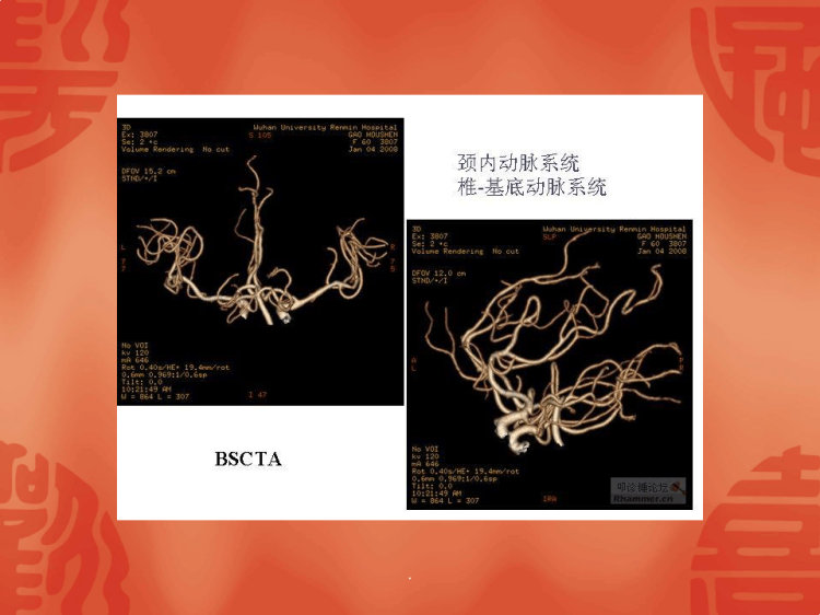 CTA头部血管成像中临床应用PPT