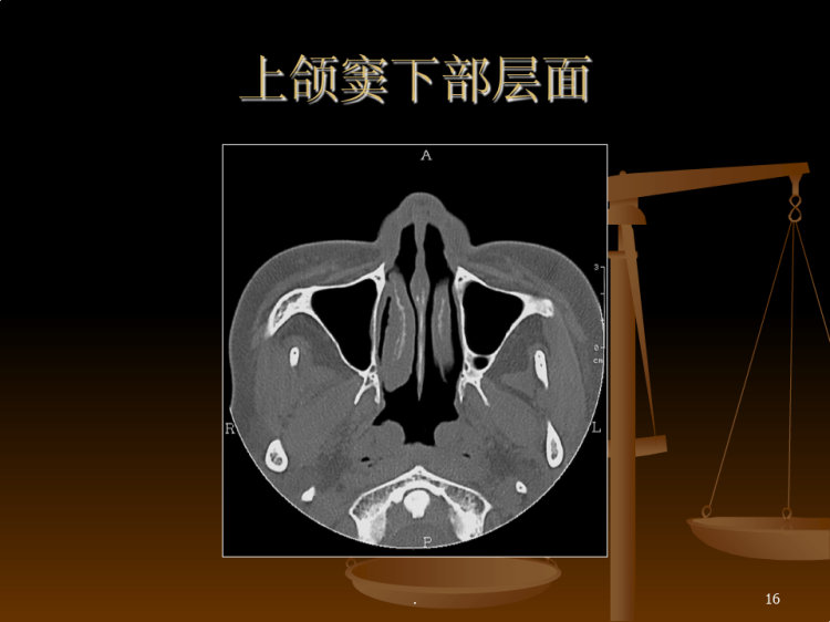 鼻窦解剖及变异CT表现PPT
