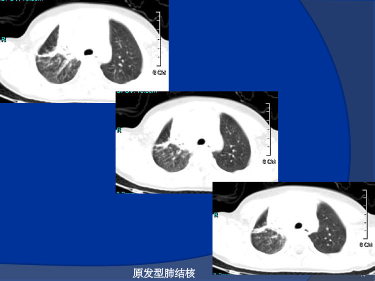 肺结核影像诊断PPT