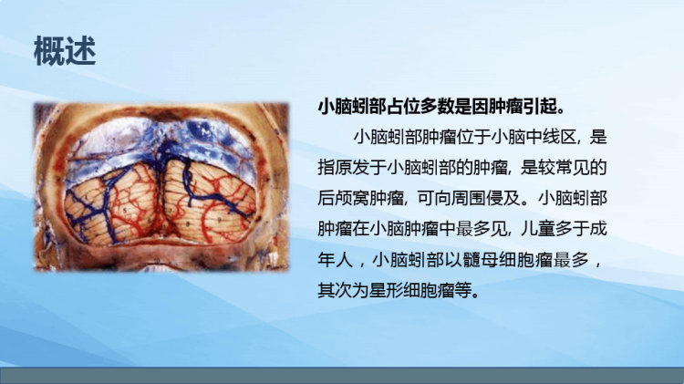 小脑蚓部占位的业务学习PPT