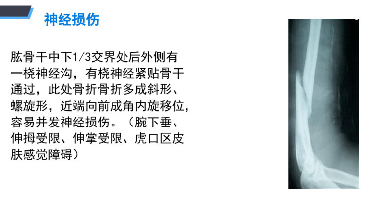肱骨干骨折手术配合PPT