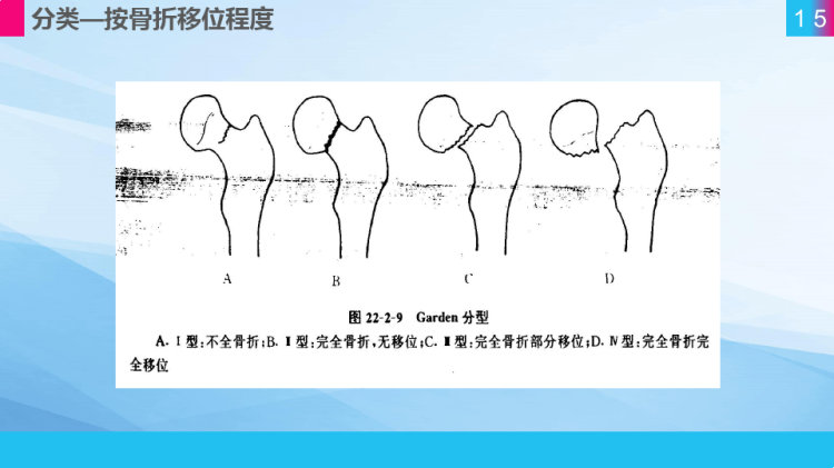 股骨颈骨折护理查房PPT