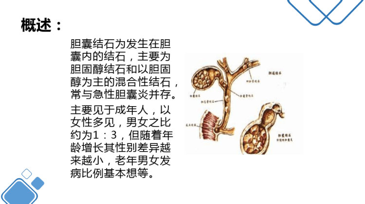 胆囊结石护理查房PPT