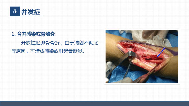 骨科胫腓骨骨折教育查房PPT