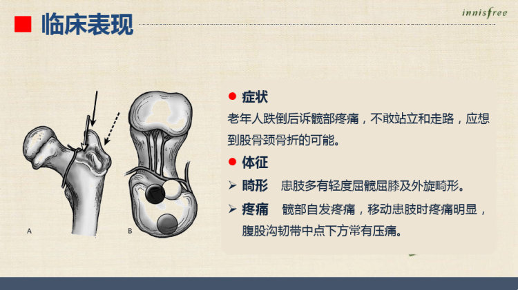 股骨颈骨折病人的护理查房PPT