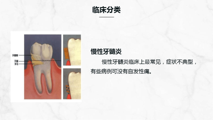 牙髓炎病人的护理查房知识PPT