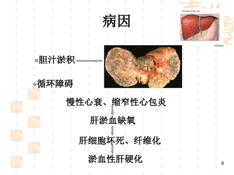肝硬化的护理PPT