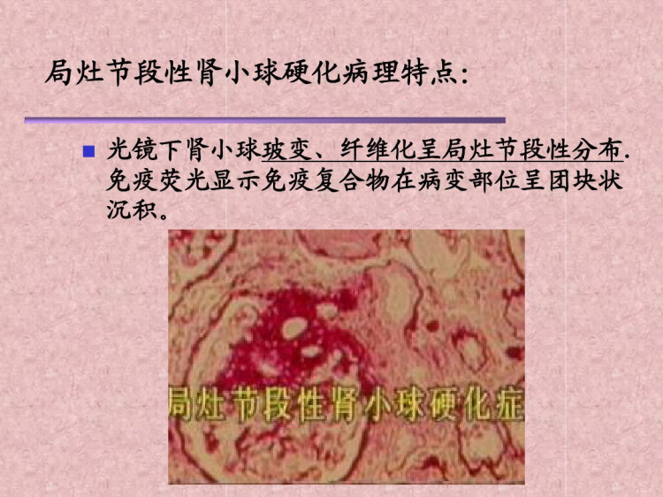 肾病综合症PPT
