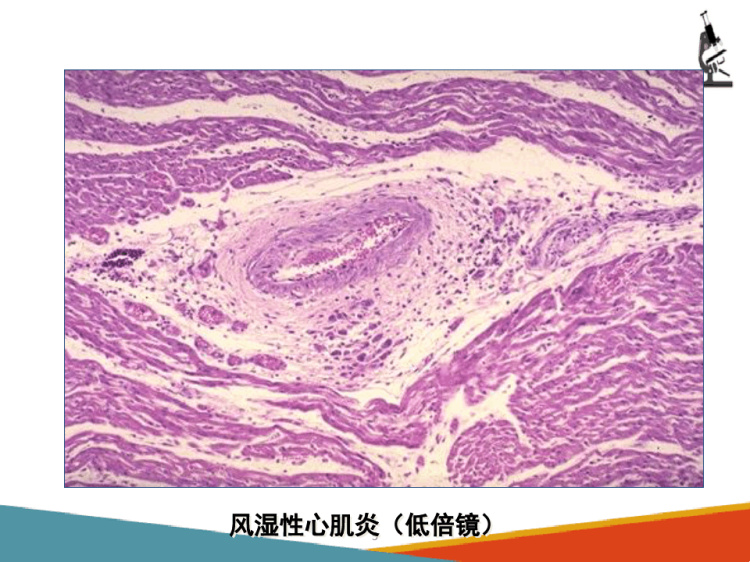 病理学：心血管系统疾病风湿病PPT课件