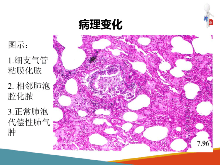 呼吸系统疾病与呼吸衰竭肺炎小叶性肺炎病理学PPT课件