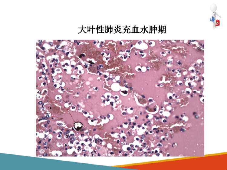 呼吸系统疾病与呼吸衰竭肺炎大叶性肺炎病理学PPT课件