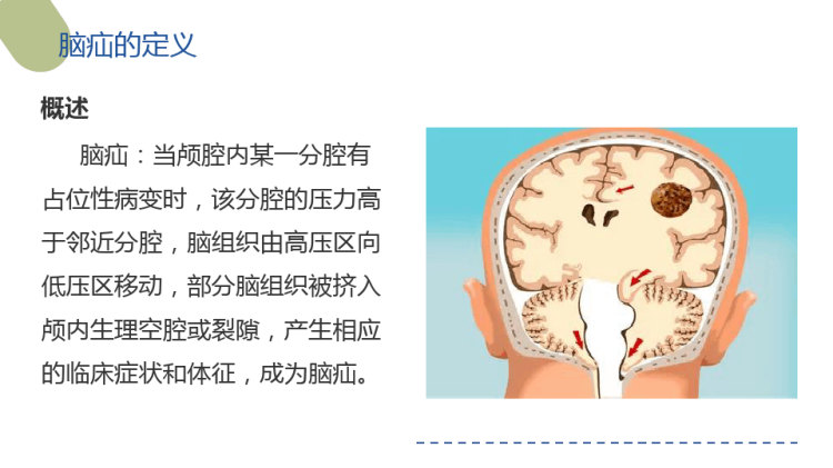 脑疝病人的相关护理常规PPT