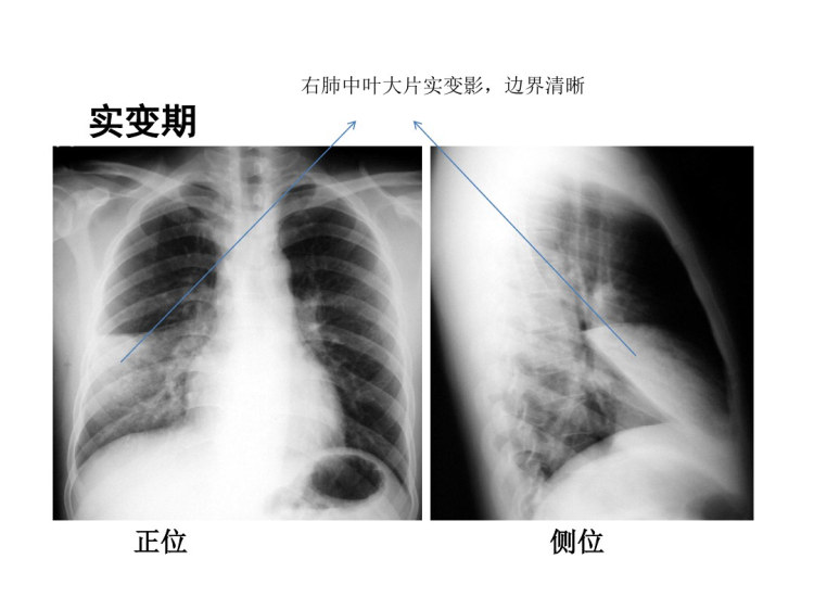 规培结业考试常见X片判读PPT